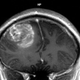 Renonancia magnética con un gioblastoma. Foto: Wikipedia
